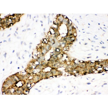 ANXA3 / Annexin A3 Antibody - Annexin A3 antibody IHC-paraffin. IHC(P): Human Mammary Cancer Tissue.