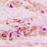 ANXA3 / Annexin A3 Antibody - Immunohistochemical analysis of Annexin A3 staining in human lung cancer formalin fixed paraffin embedded tissue section. The section was pre-treated using heat mediated antigen retrieval with sodium citrate buffer (pH 6.0). The section was then incubated with the antibody at room temperature and detected using an HRP conjugated compact polymer system. DAB was used as the chromogen. The section was then counterstained with hematoxylin and mounted with DPX.
