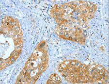 ANXA3 / Annexin A3 Antibody - Immunohistochemistry of paraffin-embedded Human cervical cancer using ANXA3 Polyclonal Antibody at dilution of 1:35.