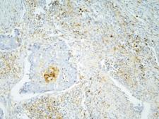 ANXA3 / Annexin A3 Antibody - IHC staining of FFPE human lung cancer with Annexin A3 antibody at 1ug/ml. HIER: boil tissue sections in pH6, 10mM citrate buffer, for 10-20 min and allow to cool before testing.