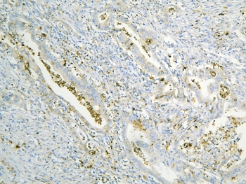 ANXA3 / Annexin A3 Antibody - IHC staining of FFPE human intestinal cancer with Annexin A3 antibody at 1ug/ml. HIER: boil tissue sections in pH6, 10mM citrate buffer, for 10-20 min and allow to cool before testing.