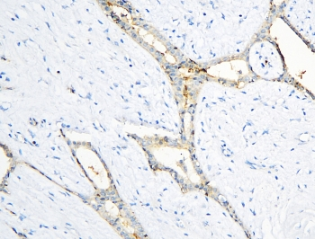 ANXA3 / Annexin A3 Antibody - IHC staining of FFPE human breast cancer with Annexin A3 antibody at 1ug/ml. HIER: boil tissue sections in pH6, 10mM citrate buffer, for 10-20 min and allow to cool before testing.
