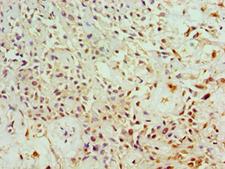 ANXA4 / Annexin IV Antibody - Immunohistochemistry of paraffin-embedded human breast cancer using antibody at 1:100 dilution.