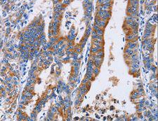 ANXA4 / Annexin IV Antibody - Immunohistochemistry of paraffin-embedded Human gastric cancer using ANXA4 Polyclonal Antibody at dilution of 1:25.