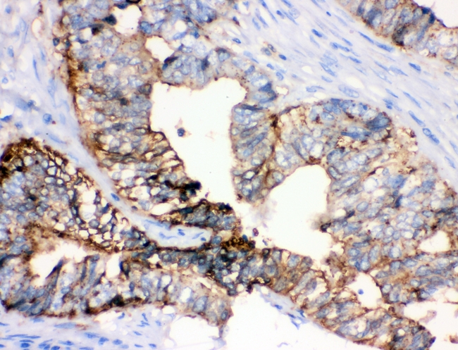 ANXA4 / Annexin IV Antibody - IHC analysis of Annexin IV using anti-Annexin IV antibody. Annexin IV was detected in paraffin-embedded section of human intestinal cancer tissues. Heat mediated antigen retrieval was performed in citrate buffer (pH6, epitope retrieval solution) for 20 mins. The tissue section was blocked with 10% goat serum. The tissue section was then incubated with 1µg/ml rabbit anti-Annexin IV Antibody overnight at 4°C. Biotinylated goat anti-rabbit IgG was used as secondary antibody and incubated for 30 minutes at 37°C. The tissue section was developed using Strepavidin-Biotin-Complex (SABC) with DAB as the chromogen.