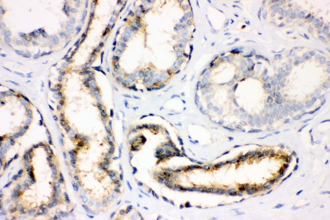 ANXA4 / Annexin IV Antibody - IHC analysis of Annexin IV using anti-Annexin IV antibody. Annexin IV was detected in paraffin-embedded section of human mammary cancer tissues. Heat mediated antigen retrieval was performed in citrate buffer (pH6, epitope retrieval solution) for 20 mins. The tissue section was blocked with 10% goat serum. The tissue section was then incubated with 1µg/ml rabbit anti-Annexin IV Antibody overnight at 4°C. Biotinylated goat anti-rabbit IgG was used as secondary antibody and incubated for 30 minutes at 37°C. The tissue section was developed using Strepavidin-Biotin-Complex (SABC) with DAB as the chromogen.