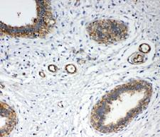 ANXA4 / Annexin IV Antibody - ANXA4 / Annexin IV antibody. IHC(P): Human Breast Cancer Tissue.