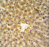 ANXA5 / Annexin V Antibody - Annexin V Antibody IHC of formalin-fixed and paraffin-embedded human hepatocarcinoma followed by peroxidase-conjugated secondary antibody and DAB staining. This data demonstrates the use of the Annexin V Antibody for immunohistochemistry.