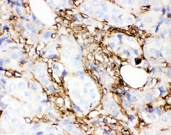 ANXA5 / Annexin V Antibody - IHC-P: Annexin V antibody testing of human breast cancer tissue