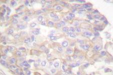 ANXA6/Annexin A6/Annexin VI Antibody - IHC of Annexin A6 (A5) pAb in paraffin-embedded human breast carcinoma tissue.