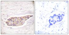 ANXA6/Annexin A6/Annexin VI Antibody - Peptide - + Immunohistochemical analysis of paraffin-embedded human breast carcinoma tissue using Annexin A6 antibody.