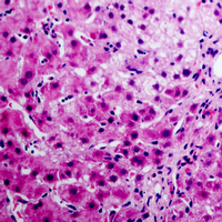 ANXA6/Annexin A6/Annexin VI Antibody - Immunohistochemical analysis of Annexin A6 staining in human liver cancer formalin fixed paraffin embedded tissue section. The section was pre-treated using heat mediated antigen retrieval with sodium citrate buffer (pH 6.0). The section was then incubated with the antibody at room temperature and detected using an HRP conjugated compact polymer system. AEC was used as the chromogen. The section was then counterstained with hematoxylin and mounted with DPX.