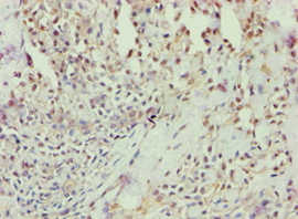 ANXA7 / Annexin VII / SNX Antibody - Immunohistochemistry of paraffin-embedded human breast cancer using antibody at 1:100 dilution.