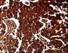 ANXA7 / Annexin VII / SNX Antibody - Immunohistochemistry of paraffin-embedded Human lung cancer using ANXA7 Polyclonal Antibody at dilution of 1:40.