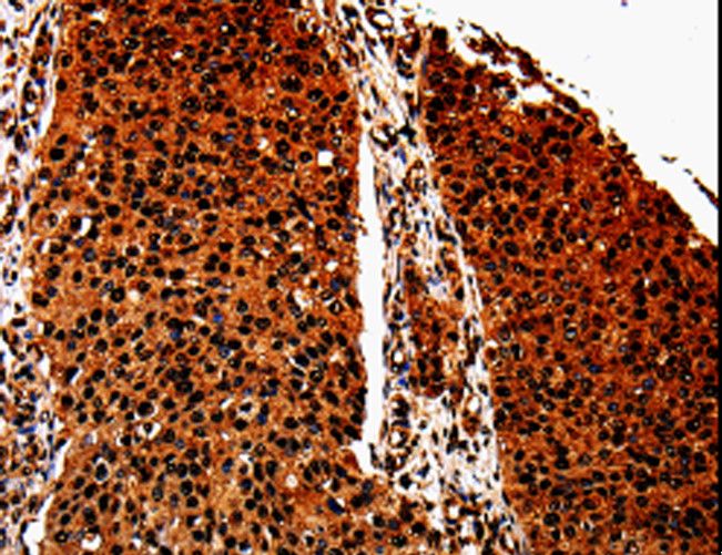ANXA7 / Annexin VII / SNX Antibody - Immunohistochemistry of paraffin-embedded Human lung cancer using ANXA7 Polyclonal Antibody at dilution of 1:40.