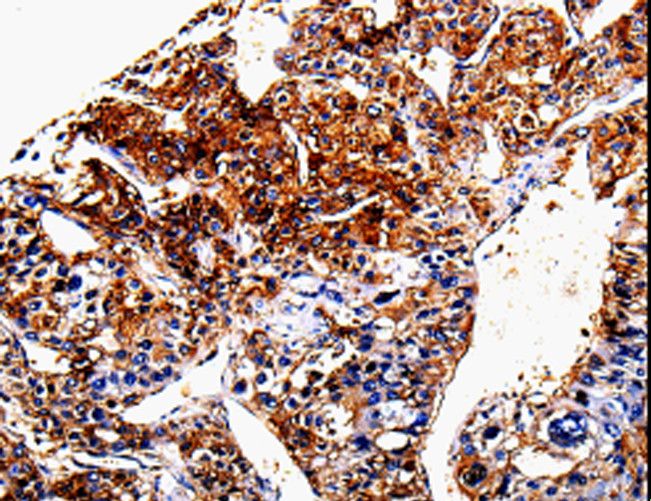 ANXA7 / Annexin VII / SNX Antibody - Immunohistochemistry of paraffin-embedded Human liver cancer using ANXA7 Polyclonal Antibody at dilution of 1:150.