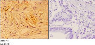 ANXA7 / Annexin VII / SNX Antibody - Immunohistochemistry (IHC) analysis of ANXA7 antibody in paraffin-embedded human colon carcinoma tissue at 1:50, showing cytoplasm,nuclear and membrane staining. Negative control (the right) using PBS instead of primary antibody. Secondary antibody is Goat Anti-R.