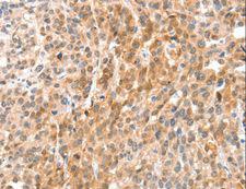ANXA8 / Annexin A8 Antibody - Immunohistochemistry of paraffin-embedded Human esophagus cancer using ANXA8 Polyclonal Antibody at dilution of 1:35.