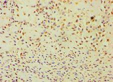ANXA8L1 Antibody - Immunohistochemistry of paraffin-embedded human breast cancer using antibody at 1:100 dilution.