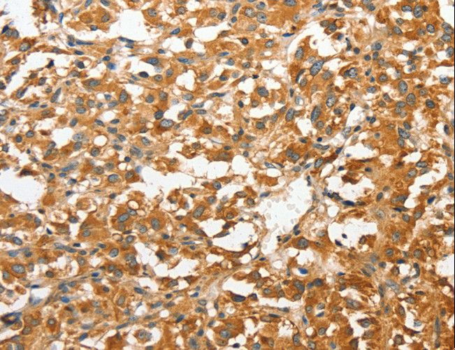 ANXA9 Antibody - Immunohistochemistry of paraffin-embedded Human liver cancer using ANXA9 Polyclonal Antibody at dilution of 1:30.