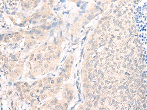 AOAH / Acyloxyacyl Hydrolase Antibody - Immunohistochemistry of paraffin-embedded Human cervical cancer tissue  using AOAH Polyclonal Antibody at dilution of 1:25(×200)