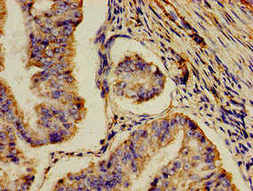 AOC3 / VAP-1 Antibody - Immunohistochemistry image of paraffin-embedded human endometrial cancer at a dilution of 1:100