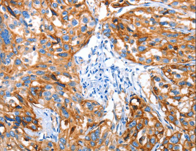 AOX1 / Aldehyde Oxidase Antibody - Immunohistochemistry of paraffin-embedded Human esophagus cancer using AOX1 Polyclonal Antibody at dilution of 1:65.