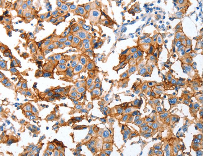 AOX1 / Aldehyde Oxidase Antibody - Immunohistochemistry of paraffin-embedded Human breast cancer using AOX1 Polyclonal Antibody at dilution of 1:65.