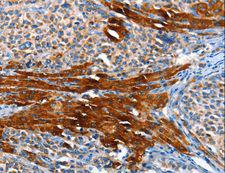 AOX1 / Aldehyde Oxidase Antibody - Immunohistochemistry of paraffin-embedded Human liver cancer using AOX1 Polyclonal Antibody at dilution of 1:65.