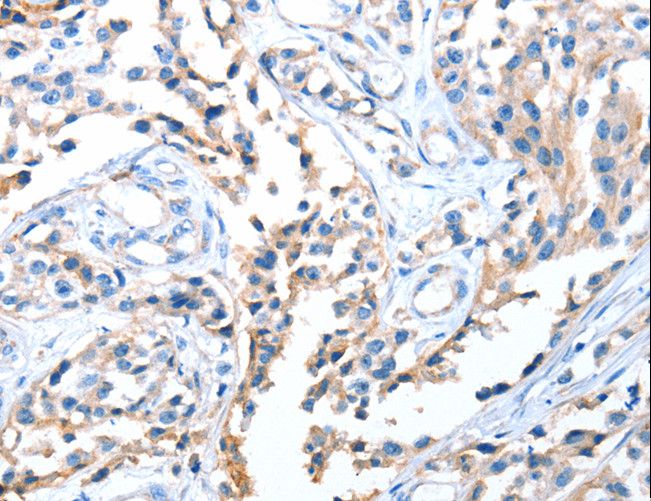 AOX1 / Aldehyde Oxidase Antibody - Immunohistochemistry of paraffin-embedded Human esophagus cancer using AOX1 Polyclonal Antibody at dilution of 1:65.