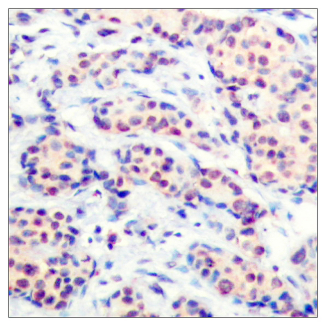 AP-1 / JUND Antibody - Immunohistochemistry analysis of paraffin-embedded human breast carcinoma tissue, using JunD Antibody. The picture on the right is blocked with the synthesized peptide.