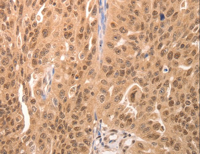 AP-1 / JUND Antibody - Immunohistochemistry of paraffin-embedded Human breast cancer using JUND Polyclonal Antibody at dilution of 1:60.