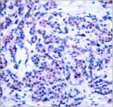 AP-1 / JUND Antibody - Detection of JunD (phospho-Ser255) in paraffin-embedded human breast carcinoma tissue.