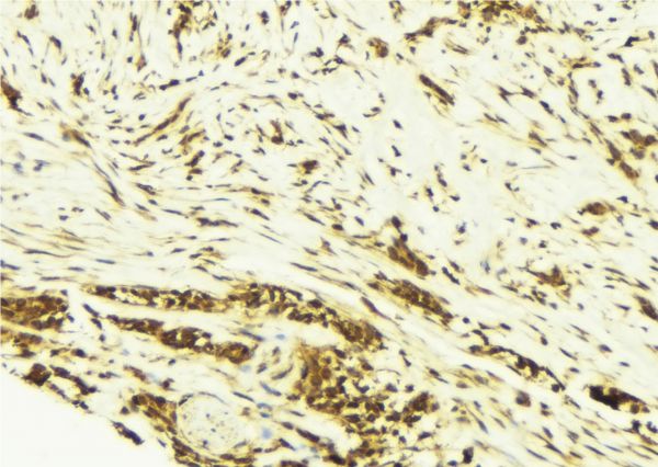 AP-1 / JUND Antibody - 1:100 staining human breast carcinoma tissue by IHC-P. The sample was formaldehyde fixed and a heat mediated antigen retrieval step in citrate buffer was performed. The sample was then blocked and incubated with the antibody for 1.5 hours at 22°C. An HRP conjugated goat anti-rabbit antibody was used as the secondary.