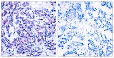AP-1 / JUND Antibody - Immunohistochemistry analysis of paraffin-embedded human breast carcinoma, using JunD (Phospho-Ser255) Antibody. The picture on the right is blocked with the phospho peptide.