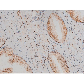 AP-1 / JUND Antibody - 1:200 staining human prostate tissue by IHC-P. The tissue was formaldehyde fixed and a heat mediated antigen retrieval step in citrate buffer was performed. The tissue was then blocked and incubated with the antibody for 1.5 hours at 22°C. An HRP conjugated goat anti-rabbit antibody was used as the secondary.