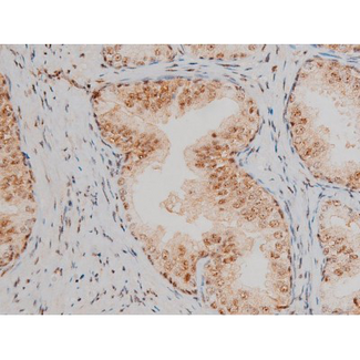 AP-1 / JUND Antibody - 1:200 staining human prostate tissue by IHC-P. The tissue was formaldehyde fixed and a heat mediated antigen retrieval step in citrate buffer was performed. The tissue was then blocked and incubated with the antibody for 1.5 hours at 22°C. An HRP conjugated goat anti-rabbit antibody was used as the secondary.