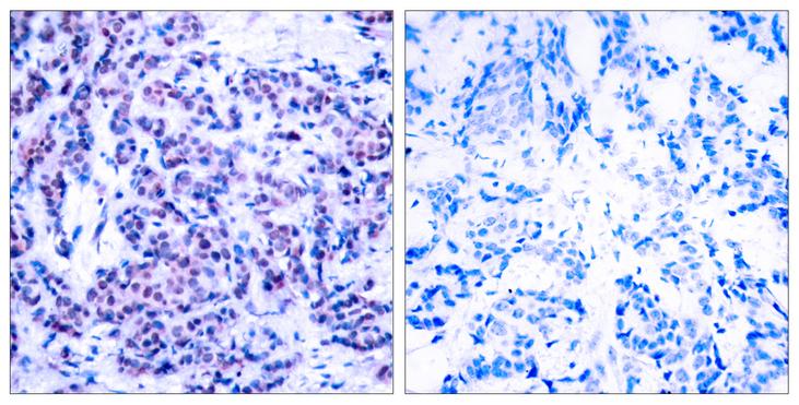 AP-1 / JUND Antibody - P-Peptide - + Immunohistochemical analysis of paraffin-embedded human breast carcinoma tissue using JunD (phospho- Ser255) antibody.