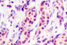 AP-1 / JUND Antibody - IHC of JunD (V249) pAb in paraffin-embedded human breast carcinoma tissue.