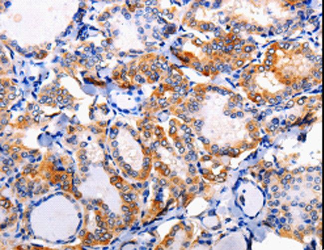 AP1B1 / BAM22 Antibody - Immunohistochemistry of paraffin-embedded Human liver cancer using AP1B1 Polyclonal Antibody at dilution of 1:100.