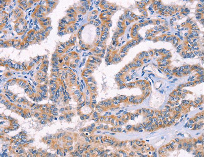AP1B1 / BAM22 Antibody - Immunohistochemistry of paraffin-embedded Human lung cancer using AP1B1 Polyclonal Antibody at dilution of 1:70.