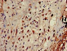 AP1G1 / Adaptin Gamma 1 Antibody - Immunohistochemistry of paraffin-embedded human lung cancer at dilution of 1:100