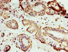 AP1M2 Antibody - Immunohistochemistry of paraffin-embedded human breast cancer using antibody at 1:100 dilution.