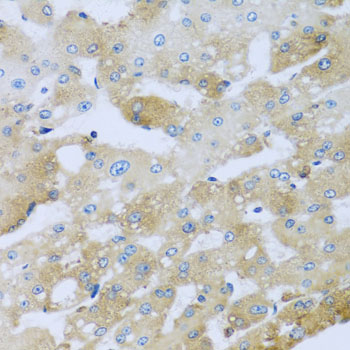 AP1M2 Antibody - Immunohistochemistry of paraffin-embedded human liver injury tissue.