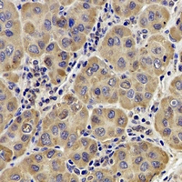 AP1M2 Antibody - Immunohistochemical analysis of AP1-mu-2 staining in human liver cancer formalin fixed paraffin embedded tissue section. The section was pre-treated using heat mediated antigen retrieval with sodium citrate buffer (pH 6.0). The section was then incubated with the antibody at room temperature and detected using an HRP conjugated compact polymer system. DAB was used as the chromogen. The section was then counterstained with hematoxylin and mounted with DPX.