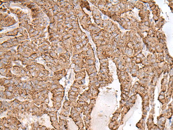 AP1S1 Antibody - Immunohistochemistry of paraffin-embedded Human thyroid cancer tissue  using AP1S1 Polyclonal Antibody at dilution of 1:65(×200)