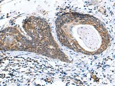 AP1S3 Antibody - Immunohistochemistry of paraffin-embedded Human esophagus cancer tissue  using AP1S3 Polyclonal Antibody at dilution of 1:70(×200)