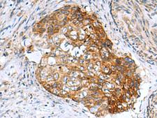 AP1S3 Antibody - Immunohistochemistry of paraffin-embedded Human cervical cancer tissue  using AP1S3 Polyclonal Antibody at dilution of 1:55(×200)
