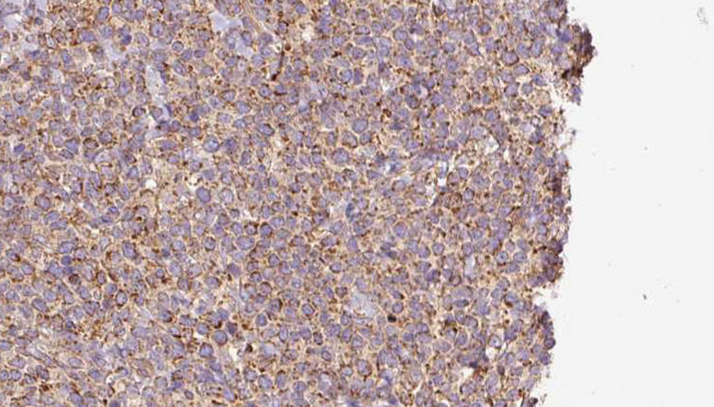 AP2A1 / AP2-Alpha Antibody - 1:100 staining human lymph carcinoma tissue by IHC-P. The sample was formaldehyde fixed and a heat mediated antigen retrieval step in citrate buffer was performed. The sample was then blocked and incubated with the antibody for 1.5 hours at 22°C. An HRP conjugated goat anti-rabbit antibody was used as the secondary.