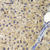 AP2A2 Antibody - Immunohistochemistry of paraffin-embedded human liver cancer tissue.